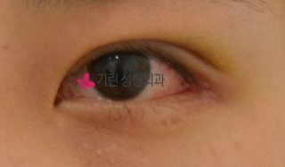 쌍꺼풀수술 일주일 붓기 >> 수술당일, 5일째, 일주일째 쌍수붓기 관련 이미지 3