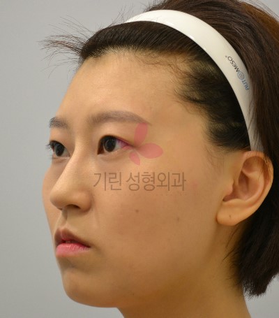 매부리코 성형의 시너지 귀족수술로 중안면부 볼륨주기 관련 이미지 1