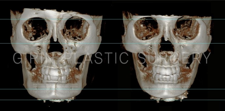 뉴브이라인, 아큐스컬프 6개월 경과 관련 이미지 1