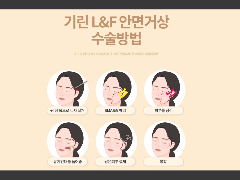 안면거상수술 효과 확실하려면 관련 이미지 12