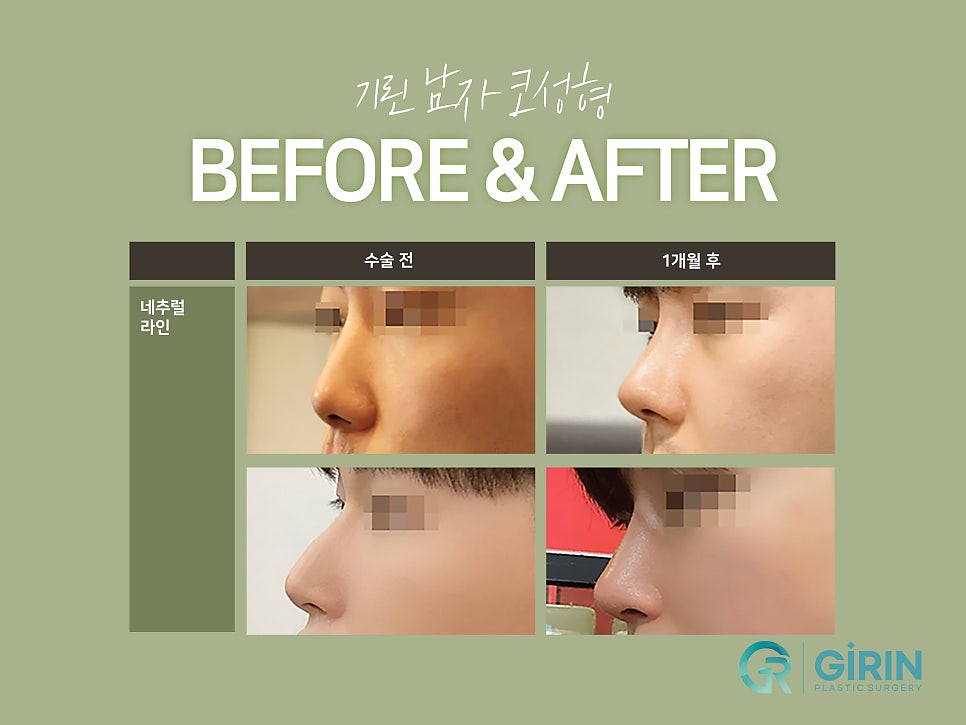 남자코성형잘하는곳 자연스러운 모습은 관련 이미지 3