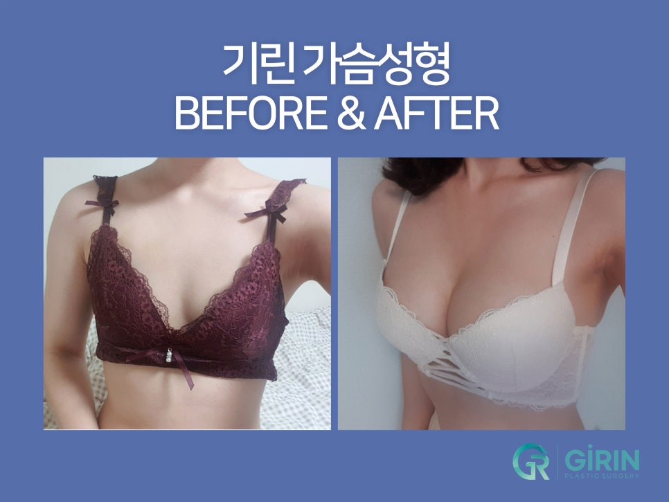 가슴확대수술 효율성 따져보며 관련 이미지 6