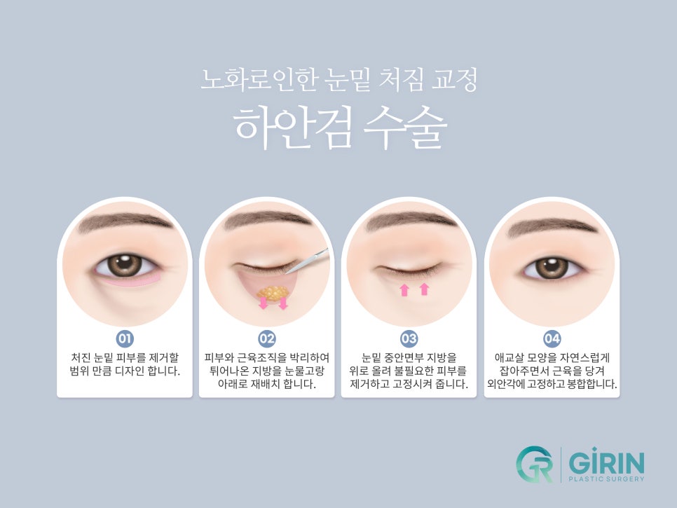 상하안검 주름 고민이 있다면 관련 이미지 7