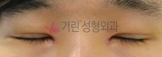 쌍꺼풀수술후기 : 일주일 경과 쌍꺼풀전후 관련 이미지 3