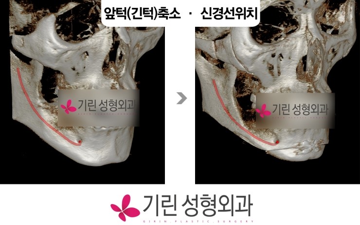 사각턱수술시 신경선의 위치비교 관련 이미지 1