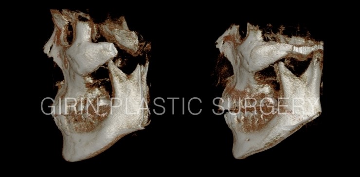 긴곡선(넓은턱), 무고정광대 전후CT 관련 이미지 2