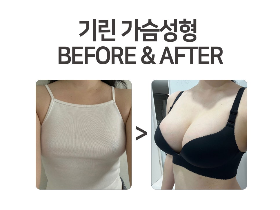 가슴성형종류 알고 선택해야 관련 이미지 2