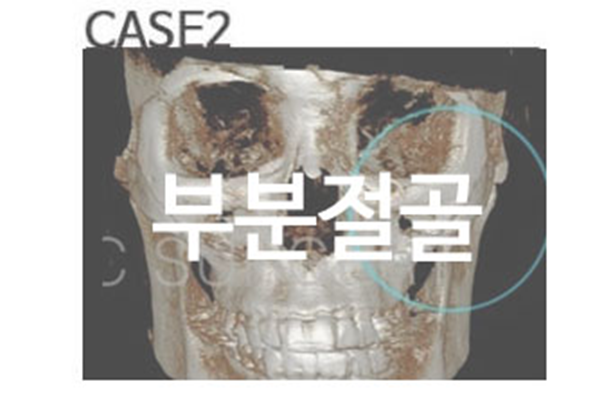 광대뼈축소술, 개인마다 다른 케이스는? 관련 이미지 3