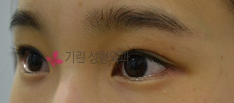 매몰법과 비절개눈매교정의 차이 관련 이미지 2