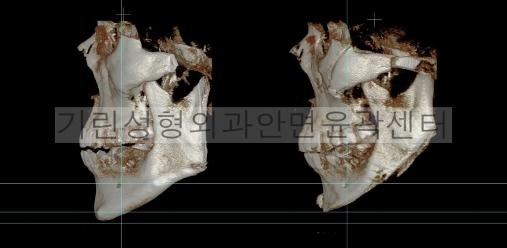 남자긴턱줄임+자가뼈앞턱수술+광대고정 수술다음날CT 관련 이미지 6