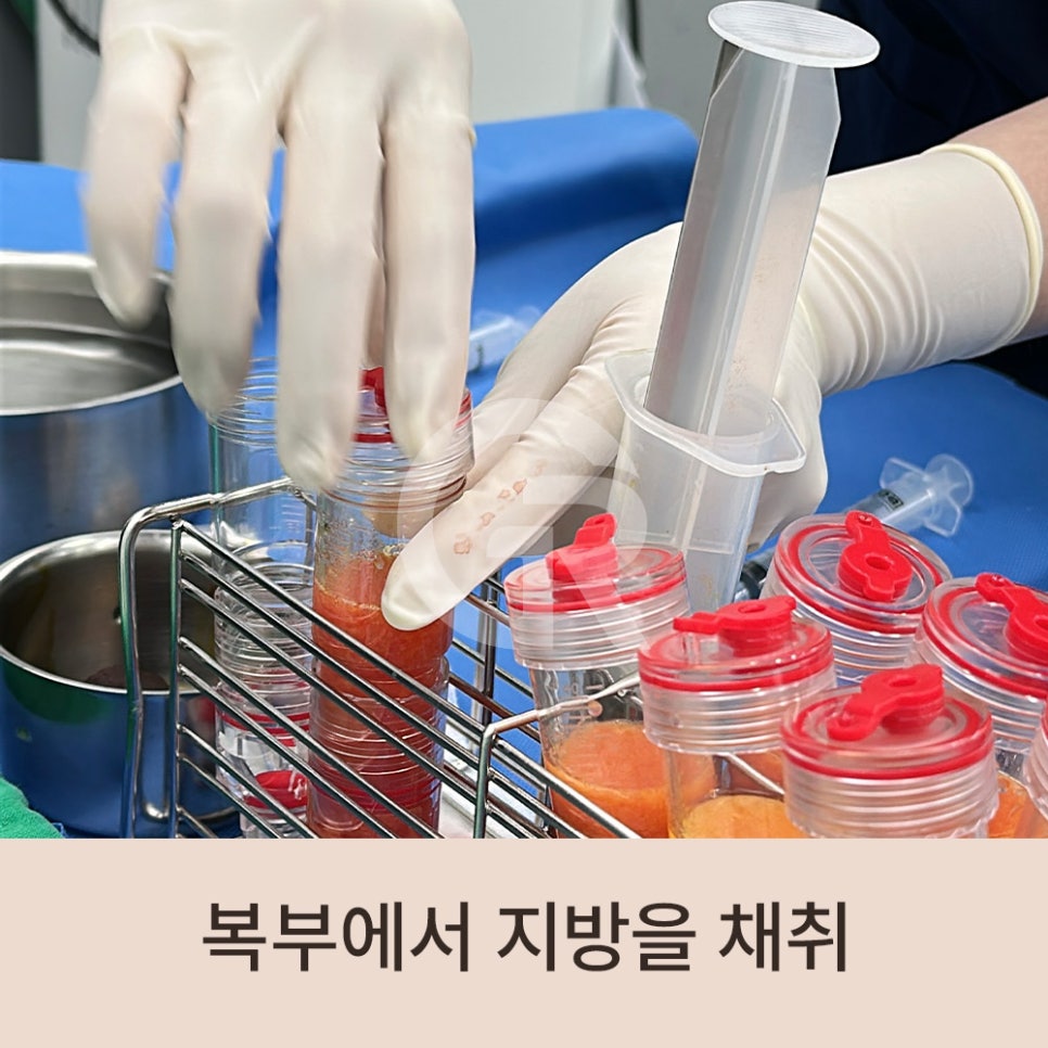 "머리숱이 없어요" 가르마 탈모 환자 줄기세포 주사 관련 이미지 4