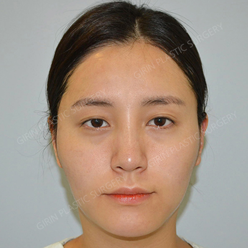 요즘 누가 티나게 성형하니? 기린성형외과 자연유착으로 미모완성♥(+후기) 관련 이미지 2