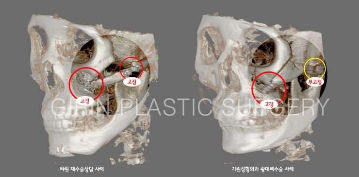 광대뼈수술 시 나사고정위치와 고정갯수가 안전에 영향을 주나요? 관련 이미지 1