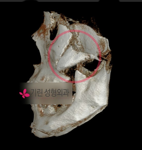 안면윤곽은 어떤부작용이 있을까 - 볼처짐현상 관련 이미지 1