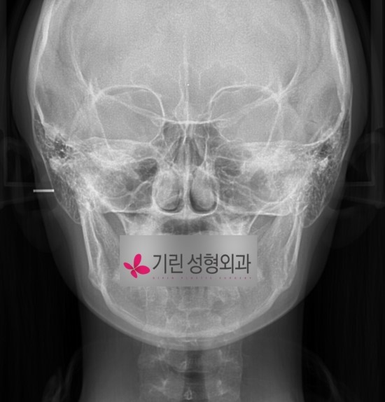 긴곡선 브이라인수술 엑스레이 (귀밑각부터 턱끝까지) 관련 이미지 1
