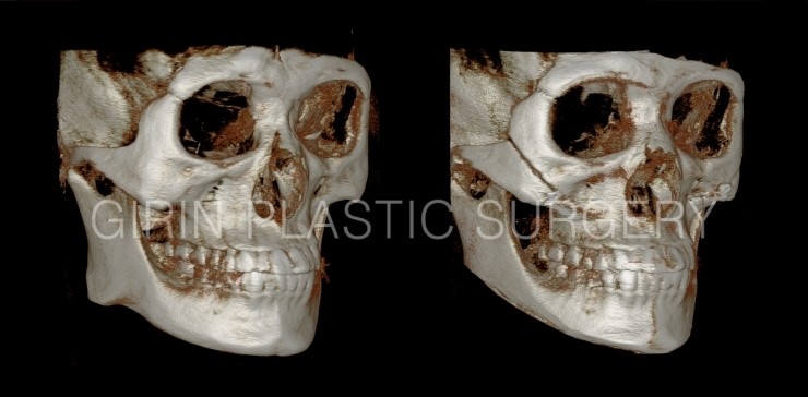 광대고정, 긴곡선절제(넓은턱) 케이스 관련 이미지 3