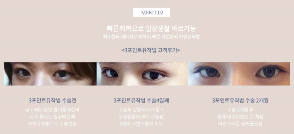 요즘 누가 티나게 성형하니? 기린성형외과 자연유착으로 미모완성♥(+후기) 관련 이미지 6