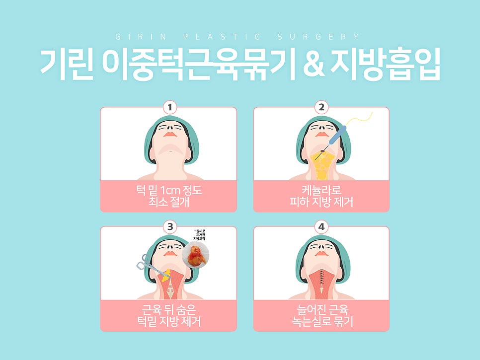 이중턱지방흡입 고려하고 있다면 관련 이미지 5