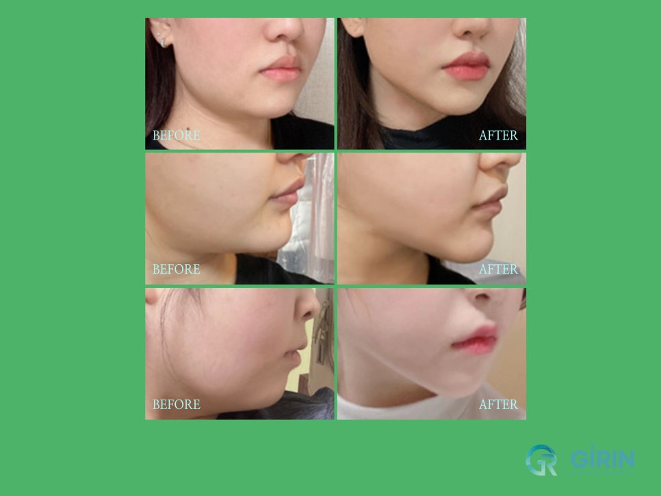 이중턱수술 확실히 효과 보려면 관련 이미지 9