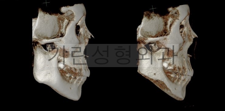 퇴원시 촬영한 긴곡선사각턱 CT영상/ 8일차 경과사진 관련 이미지 4