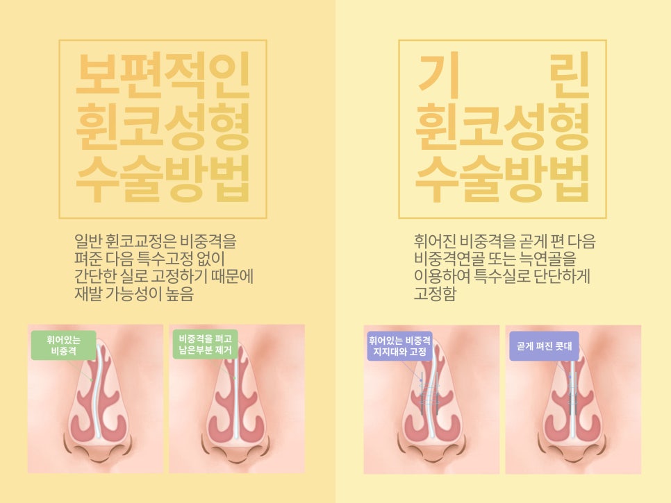 여자코성형 원하는 라인 고려하여 관련 이미지 6