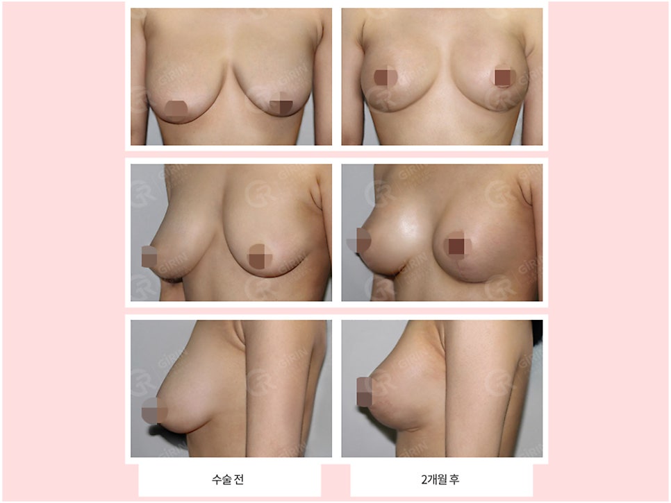 출산후 가슴수술 필요하다 느낀다면 관련 이미지 9