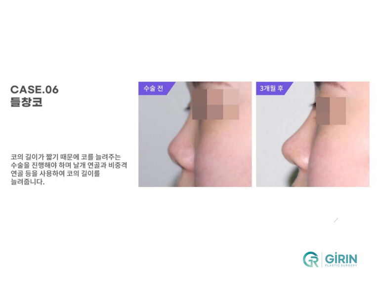 무보형물 코성형 안전하게 잘하는 곳 관련 이미지 11