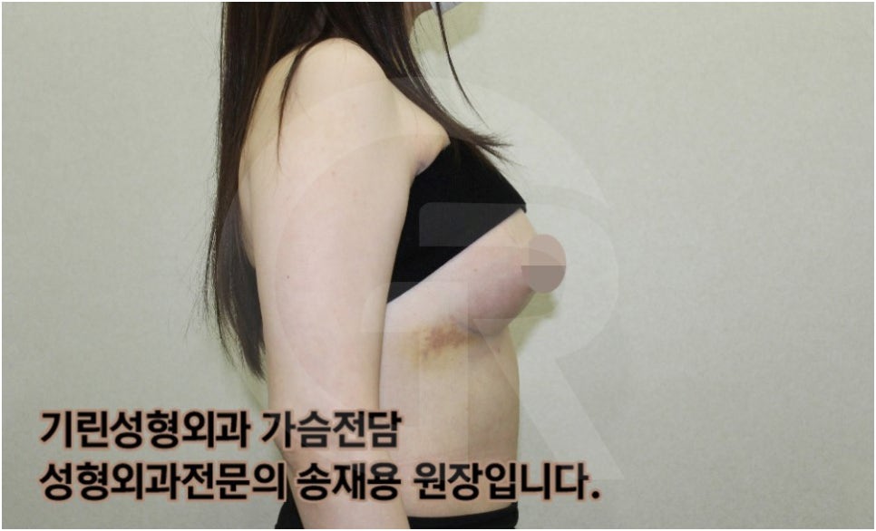 가슴확대수술 후 관리방법, 실제사례 알아보다. [기린성형외과의원_Dr.송재용] 관련 이미지 7