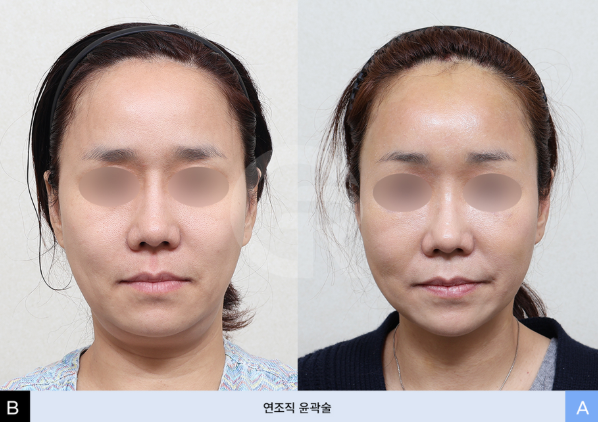 연조직윤곽술이란? 얼굴이 커 보이는 이유, 꼭 뼈 때문만은 아닙니다 관련 이미지 3