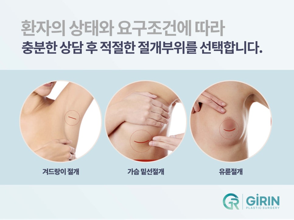 멘토가슴성형 다른 점이 무엇일까? 관련 이미지 8