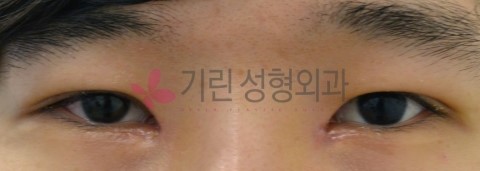 실밥제거가 없는 비절개눈매교정술 (전후사진) 관련 이미지 3