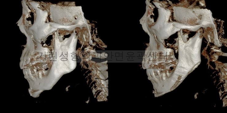 윤곽부작용사례- 이차각재수술CT 관련 이미지 3