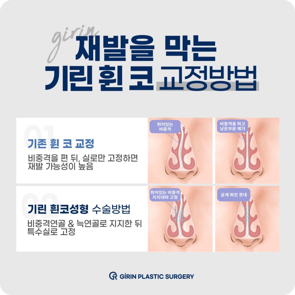 코성형잘하는곳? 강남 기린성형외과를 찾는 이유는 OOO이다 관련 이미지 4