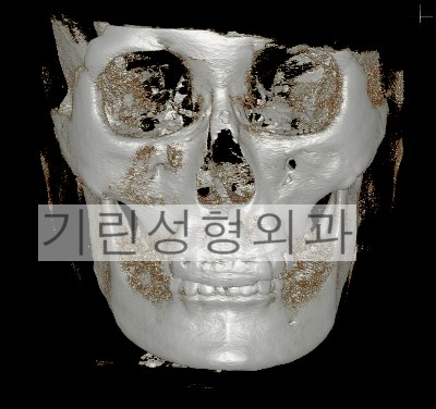 귀뒤사각턱수술 후 부작용: 효과없는 경우 관련 이미지 4