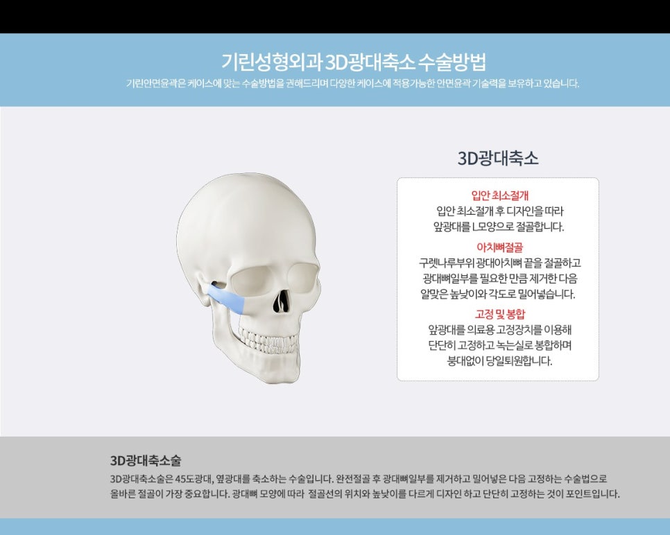 기린 성형외과는 광대축소술을 어떻게 진행하나요? 관련 이미지 3