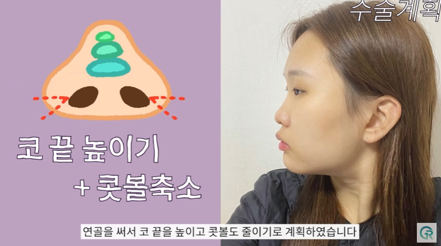 [기린성형외과] 작고 답답한 눈, 뭉뚝하고 낮은 복코 탈출!_눈성형, 코성형 수술일지 관련 이미지 8