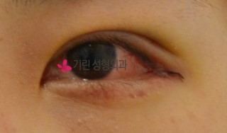 쌍꺼풀수술 일주일 붓기 >> 수술당일, 5일째, 일주일째 쌍수붓기 관련 이미지 2