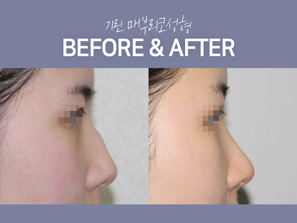 매부리코수술후기 방법까지 확인해 관련 이미지 4