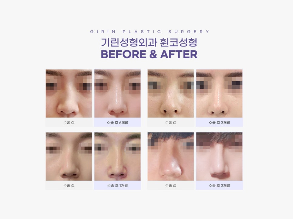 휜코성형잘하는곳 꼼꼼하게 따져보자 관련 이미지 2