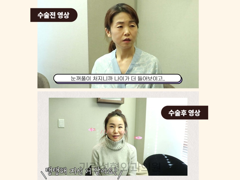 상안검수술회복기간 확인하자 관련 이미지 1