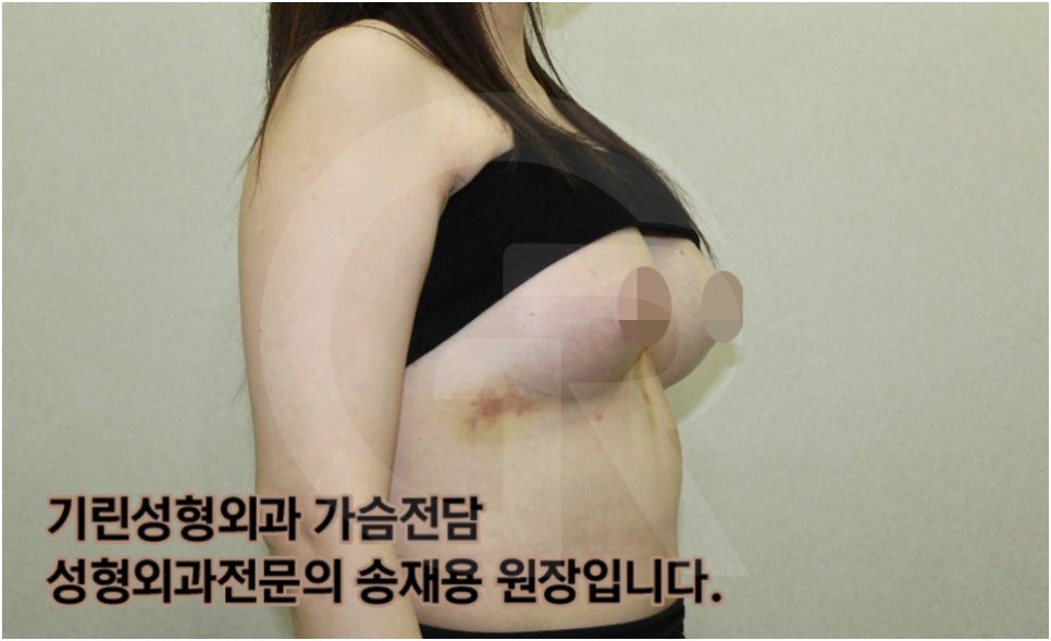가슴확대수술 후 관리방법, 실제사례 알아보다. [기린성형외과의원_Dr.송재용] 관련 이미지 6