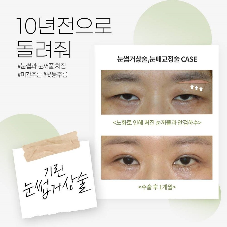 중년눈성형 처진눈수술 비절개로 가능? 관련 이미지 2