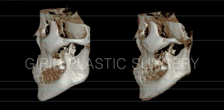 비대칭교정, 긴턱교정 22일경과 관련 이미지 5