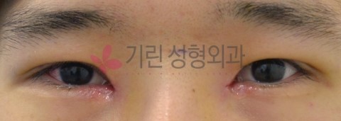 실밥제거가 없는 비절개눈매교정술 (전후사진) 관련 이미지 2