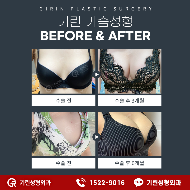 기린성형외과 가슴성형 가격 벨라젤 가슴성형 후기 관련 이미지 10