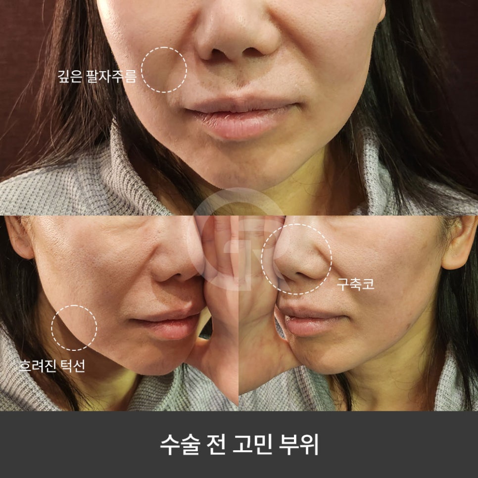 깊은 팔자주름 때문에 미니거상을 진행한 케이스(+코재수술) 관련 이미지 4
