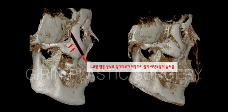 광대뼈수술 시 나사고정위치와 고정갯수가 안전에 영향을 주나요? 관련 이미지 3