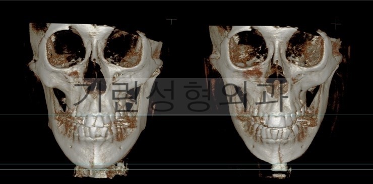 뉴브이라인 긴턱축소 사례 관련 이미지 1