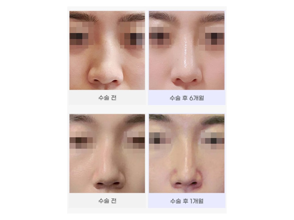 강남기능코성형 원인과 필요성 생각하여 관련 이미지 3