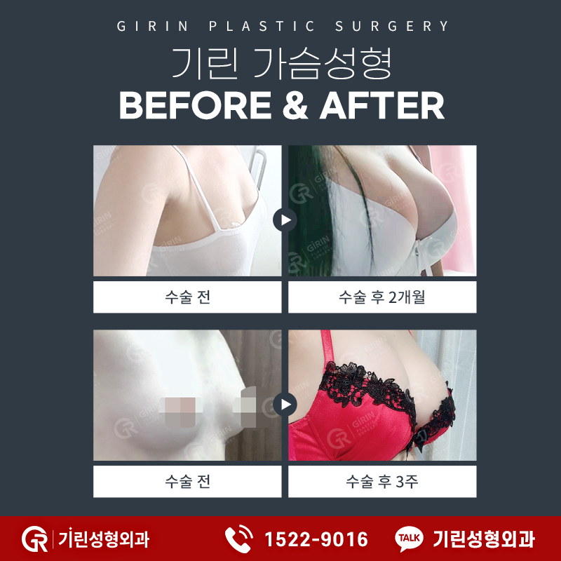 기린성형외과 가슴성형 가격 벨라젤 가슴성형 후기 관련 이미지 9